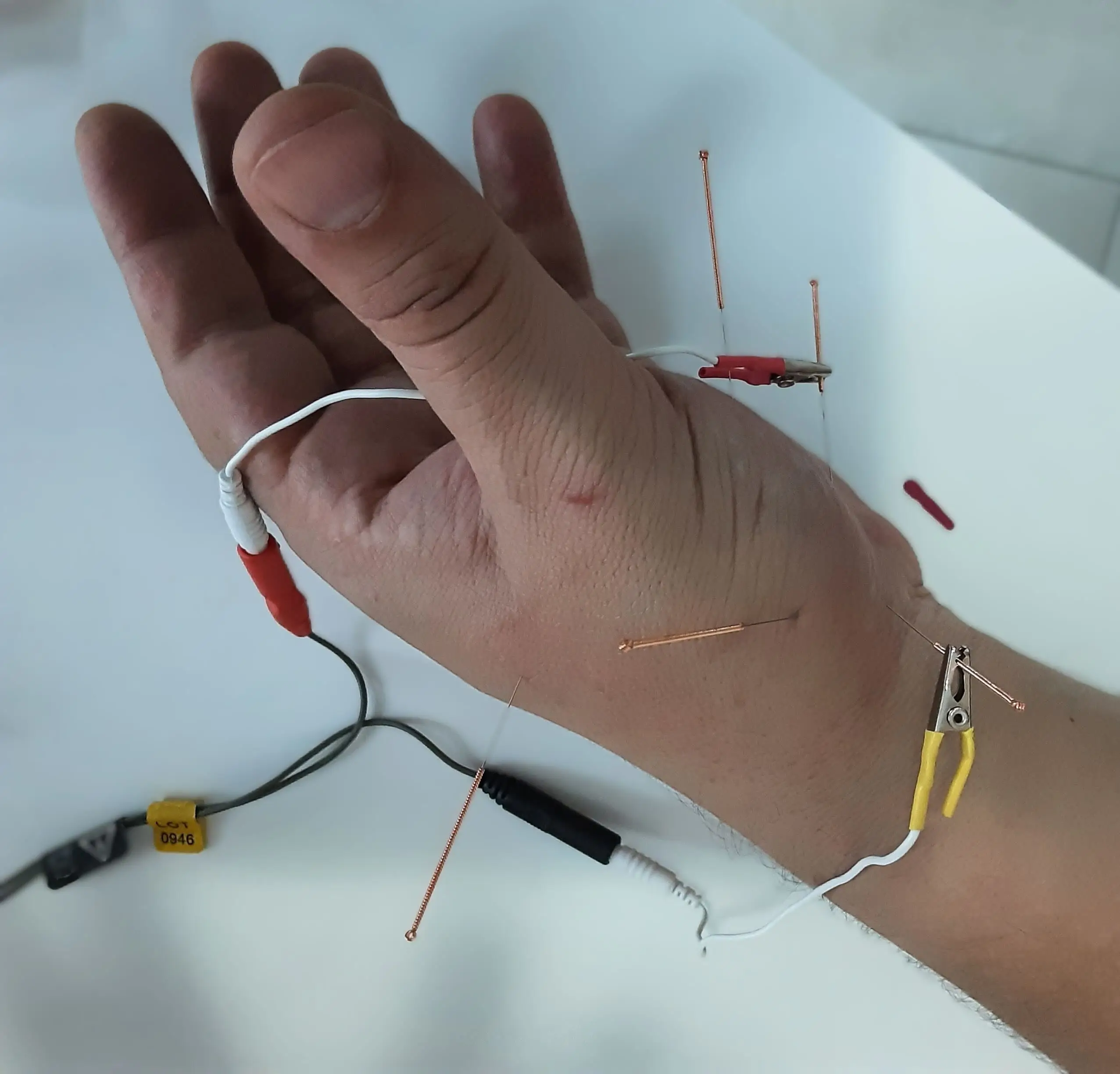 Acupuncture - physiotherapy service